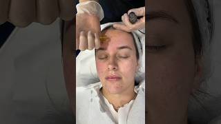 Microneedling with PRP  Dr Medispa [upl. by Goulder]