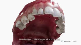 Palatal Expansion [upl. by Lianne54]