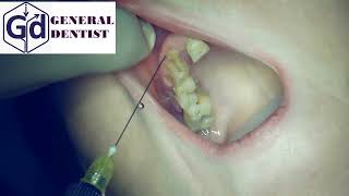 Infiltration anesthesia for extraction 12 tooth [upl. by Arreic913]