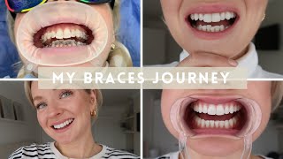 MY ADULT BRACES JOURNEY TEETH TRANSFORMATION WEARING FIXED CERAMIC BRACES WITH BEFORE AND AFTERS [upl. by Demp]