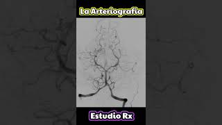 LA ARTERIOGRAFIA ✅👍 shorts radiologia [upl. by Oman]