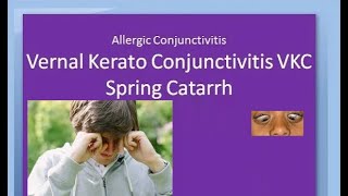 Ophthalmology 088 a Vernal KeratoConjunctivitis VKC Spring Catarrh Allergic Horner Tranta Eye [upl. by Alek]