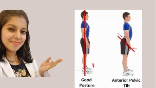 Anterior Pelvic Tilt [upl. by Nnaer]