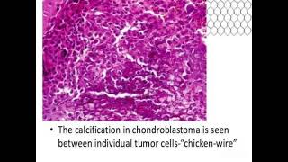 Chondroblastoma shows Chiken wire calcification [upl. by Eelyram]