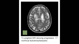 Progressive Multifocal Leukoencephalopathy PML [upl. by Neirrad121]