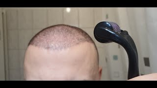 Minoxidil amp Dermarolling Results 6 MONTHS  Month by Month Progress [upl. by Ennaillek]