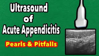 Ultrasound of Acute Appendicitis Pearls and Pitfalls [upl. by Cassi]