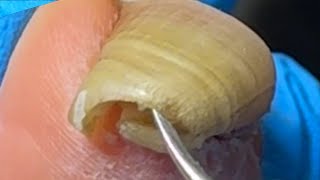 Extremely long ingrown toenailsThe patient has not had a pedicure for 4 months【Xue Yidao】 [upl. by Reggie]