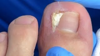 UNHA MUITO ENCRAVADAINGROWN TOENAIL  nails manicure unhaencravada [upl. by Yruoc763]