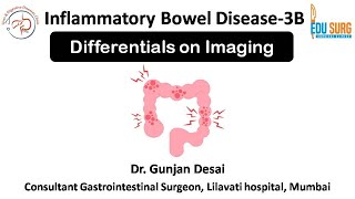 How Imaging Helps Distinguish Ulcerative Colitis vs Crohns Disease amp Differential Diagnoses [upl. by Mayfield298]