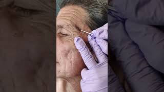 Acne extraction of blackheads and whiteheads popping pimples in Los Angeles [upl. by Fenella435]