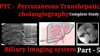 Percutaneous Transhepatic Cholangiography  PTC  Procedure  Biliary imaging system part  5 [upl. by Etnovaj]