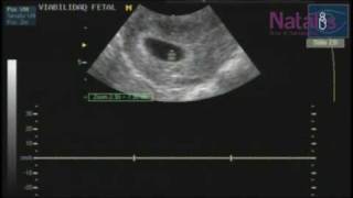 Ultrasonido Viabilidad Fetal [upl. by Vharat]