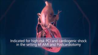 Impella® Heart Pump Animation For Physicians [upl. by Sorazal]