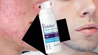 COMO CURE MI ACNE CON PEROXIDO DE BENZOLIO Y ADAPALENO Epiduo 100 EFECTIVO [upl. by Leiruh]