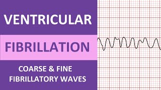 Ventricular Fibrillation VFib ECG Interpretation Nursing Heart Rhythms NCLEX ACLS [upl. by Nuawad]