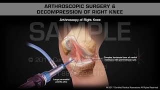 Arthroscopic Surgery amp Decompression of Right Knee [upl. by Nylqcaj]