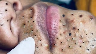 Top blackheads removal  acne treatment and very very satisfying [upl. by Aivatan]