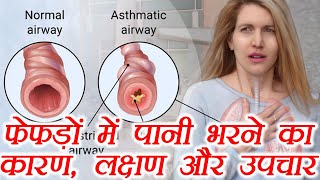 Lungs Problem amp Treatment फेफड़ों में पानी भरने का कारण लक्षण और उपचार  Boldsky [upl. by Norma]