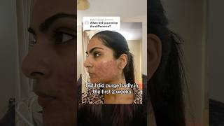 When did I start seeing accutane results acne accutane skincare [upl. by Adlog]