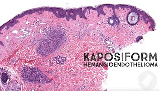 Kaposiform Hemangioendothelioma amp Tufted Angioma pathology dermpath dermatology dermatopathology [upl. by Fadden]