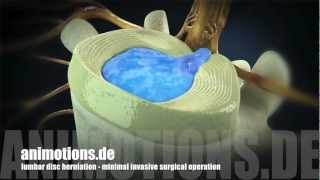 Herniation quotlumbarquot Treatment Surgery 3D Animation [upl. by Atiloj929]