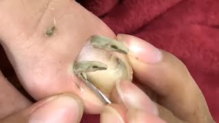 HOW TO CUT THICK TOENAILS  Toenail Cleaning Satisfying [upl. by Odraode]