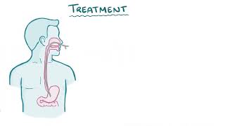 Superior Mesentric Artery Syndrome  Osmosis [upl. by Prem]