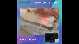 Does 1470nm laser really work for body lipolysis test this video to see how it is effective [upl. by Ylrak]