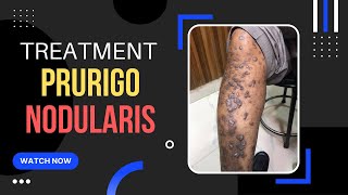 Prurigo Nodular Eczema Treatment ITCHY Skin bump एक्जिमा इलाज Dr Uttam Lenka [upl. by Yro302]