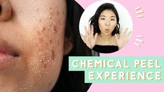 ✂ Chemical Peel for Acne amp Scars Before amp After [upl. by Kemme299]