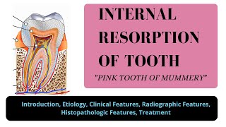 INTERNAL RESORPTION OF TOOTH I PINK TOOTH OF MUMMERY I ODONTOCLASTOMA I ORAL PATHOLOGY [upl. by Ynnam429]