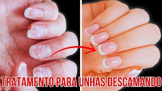 Unhas Descamando Causas Tratamentos e Como Prevenir [upl. by Einnaffit403]