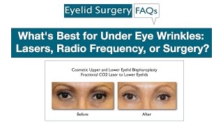 Whats Best for Under Eye Wrinkles Lasers Radio Frequency or Surgery [upl. by Eceinhoj622]