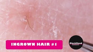 Ingrown Hair RemovalExtraction 1 [upl. by Marilou]