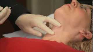 Laryngeal Botox Injection  Dr Ekbom at Mayo Clinic [upl. by Anaimad]