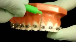 Bracesquestionscom  Brushing With Braces How to Brush Teeth [upl. by Ajoop]