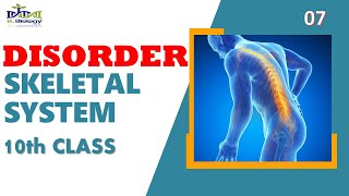 Disorder of Skeletal system  10th Class  BurhanBiology [upl. by Kerri]