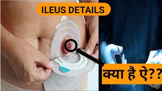 understanding ILEUS [upl. by Enilav648]