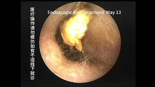 Clean up cerumen embolism every Monday [upl. by Eirrehs224]