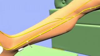 Heres how percutaneous tibial nerve stimulation PTNS provides relief from overactive bladder [upl. by Etteneg]