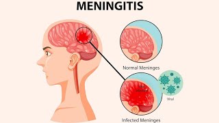 Meninges  Meningitis symptoms Diagnosis And Treatments [upl. by Northrop]