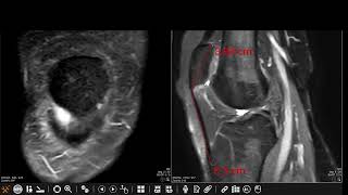 Patellar tendonlateral femoral condyle friction syndrome Hoffa fat pad impingement syndrome [upl. by Stauffer]