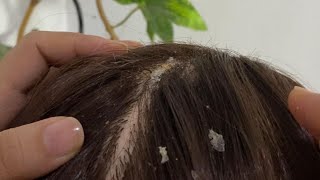 ASMR  Dandruff Removal amp Scalp Check Extremely Satisfying [upl. by Dun]