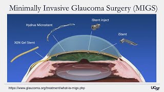 Understanding Glaucoma Diagnosis Treatment and Research on the Horizon [upl. by Hesther]