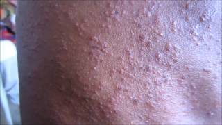 Sweat Rash Miliaria Profunda [upl. by Jochebed]