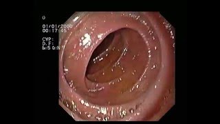 Gastric Erosions [upl. by Strader995]