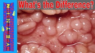 Studying Crohns Disease vs Ulcerative Colitis in Nursing School [upl. by Amiel]