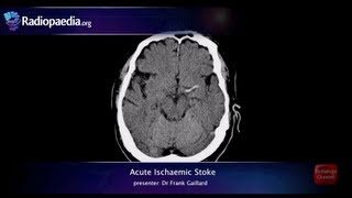 Stroke Acute infarction  radiology video tutorial CT MRI angiography [upl. by Haramat]