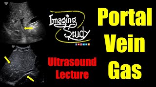 Portal Vein Gas  Ultrasound Lecture  Imaging Study [upl. by Naesyar]